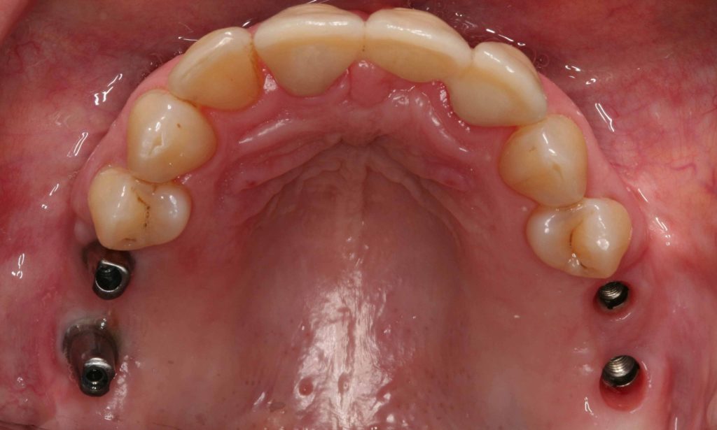 Fall 5 festsitzende Kronen auf Implantaten 1