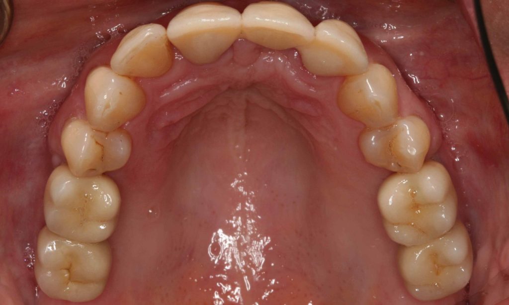 Fall 5 festsitzende Kronen auf Implantaten 2